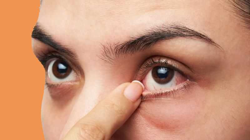 Lẹo mắt là một loại bệnh lý thường gặp ở mắt
