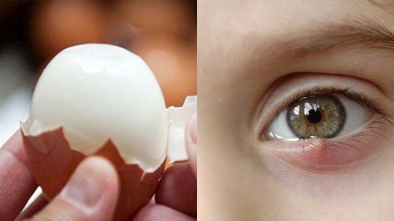 Lăn trứng gà trị lẹo mắt hiệu quả