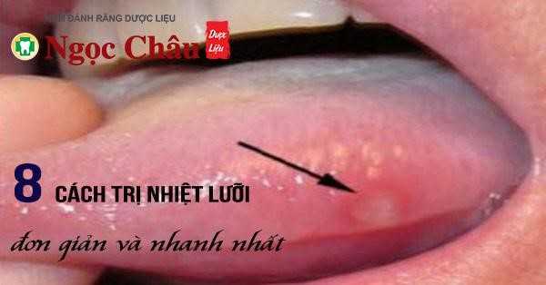 Hình ảnh Nhiệt lưỡi