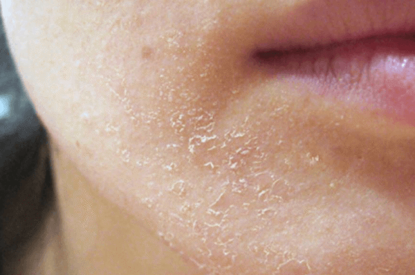 da mặt bị sần sùi là gì
