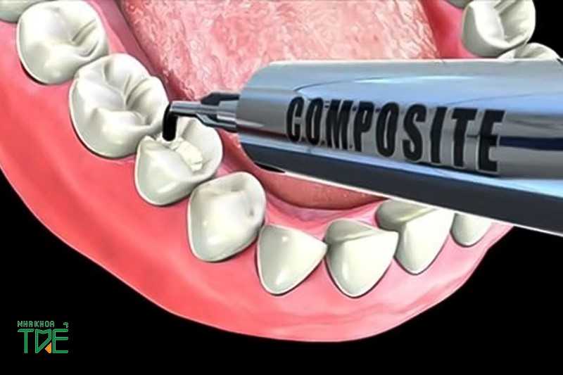 Vật liệu hàn răng tại Nha khoa Trẻ được làm từ Composite an toàn, lành tính
